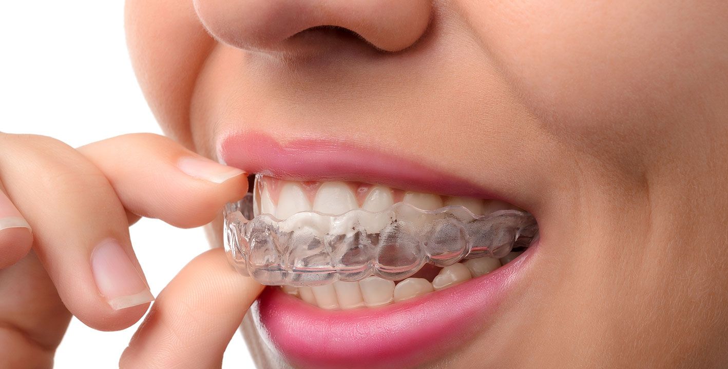 Invisalign clear aligner treatment at Renova Dental in Stouffville