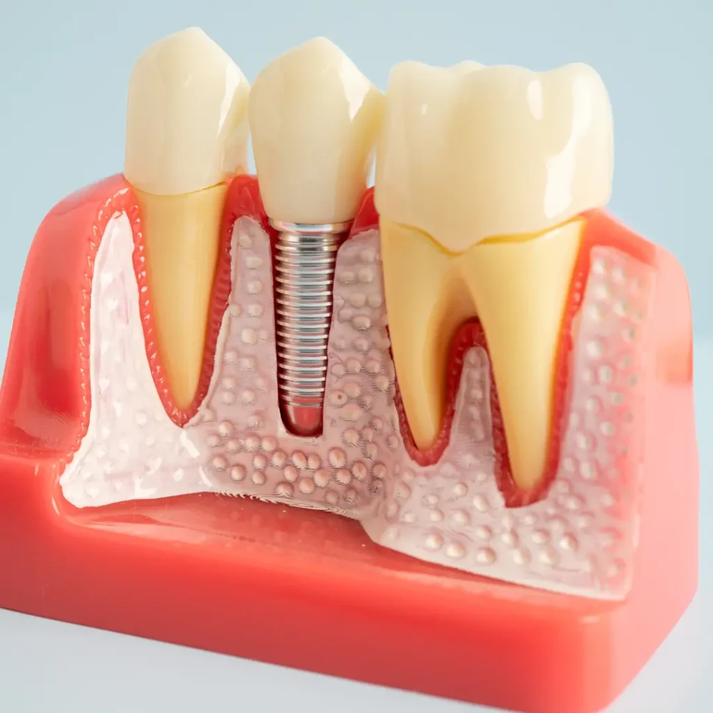 Model of a dental implant between two natural teeth, illustrating the dental bridge vs implant choice