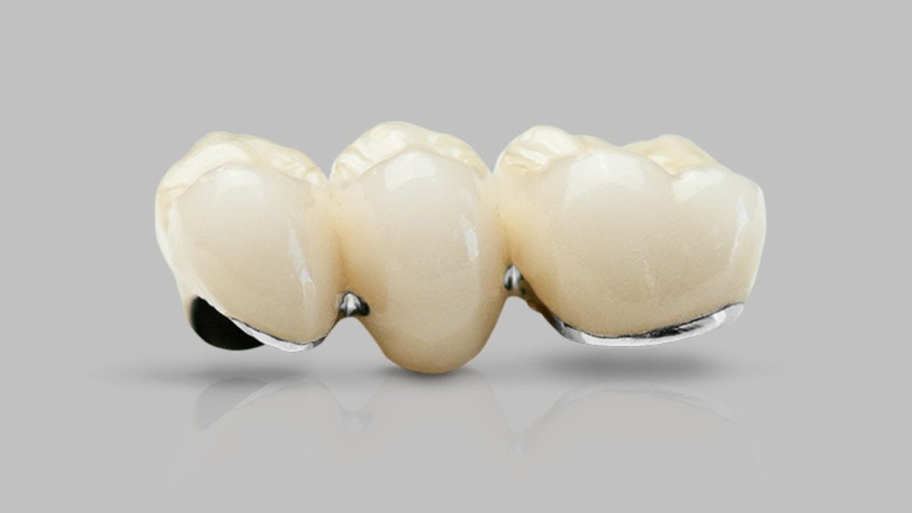 Dental crown that sits on top of a dental implant, one of the three parts you pay for